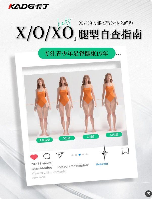卡丁X/O/XO腿型自查指南 90%的人都搞错的体态问题
